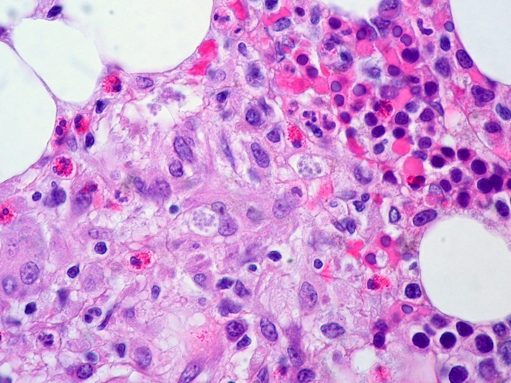 Fungal Infection in Bone Marrow