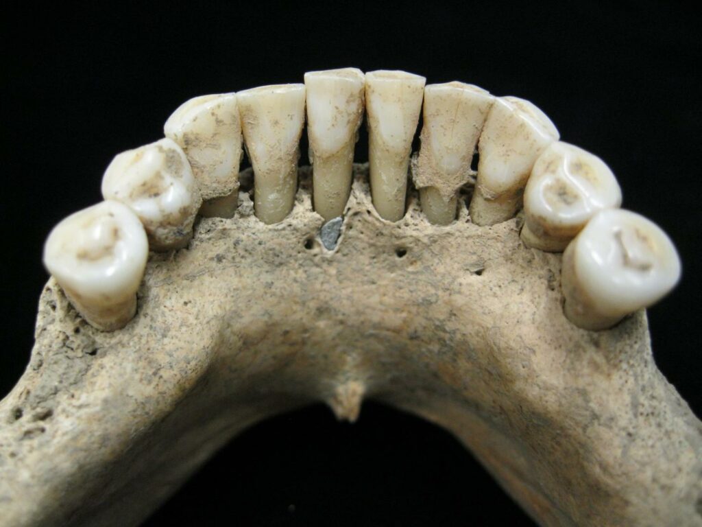 Dental calculus jaw and teeth photo