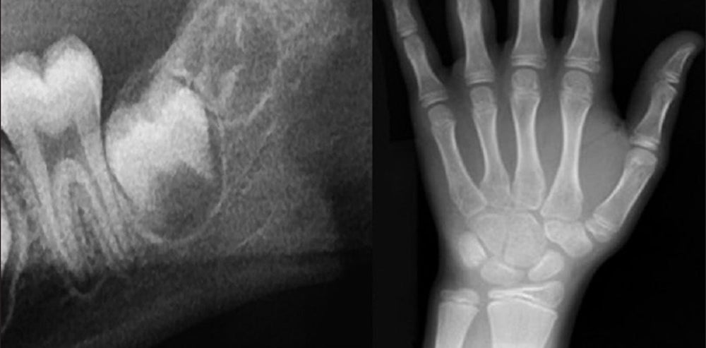 teeth and bone x-ray
