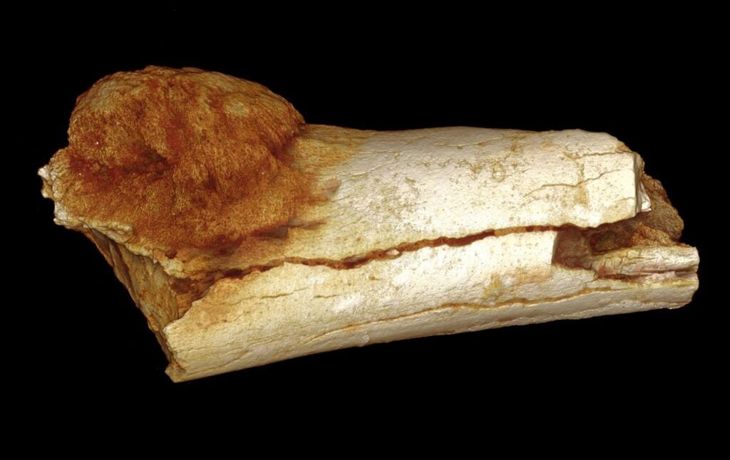 This foot bone dates back around 1.7 million years and contains a large, malignant tumor.