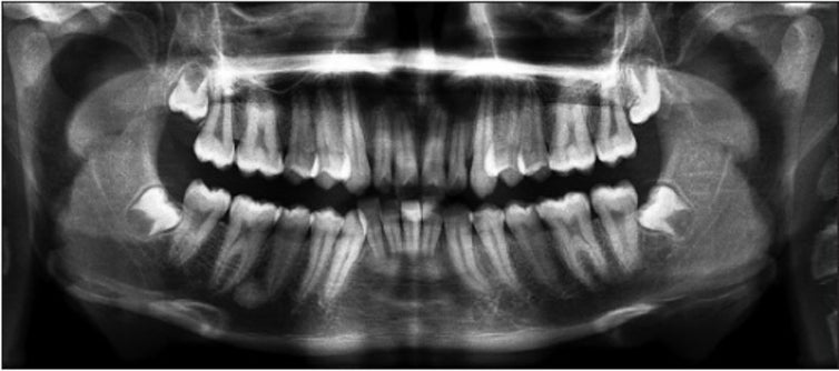 X-ray of a mouth with wisdom teeth emerging on the outside