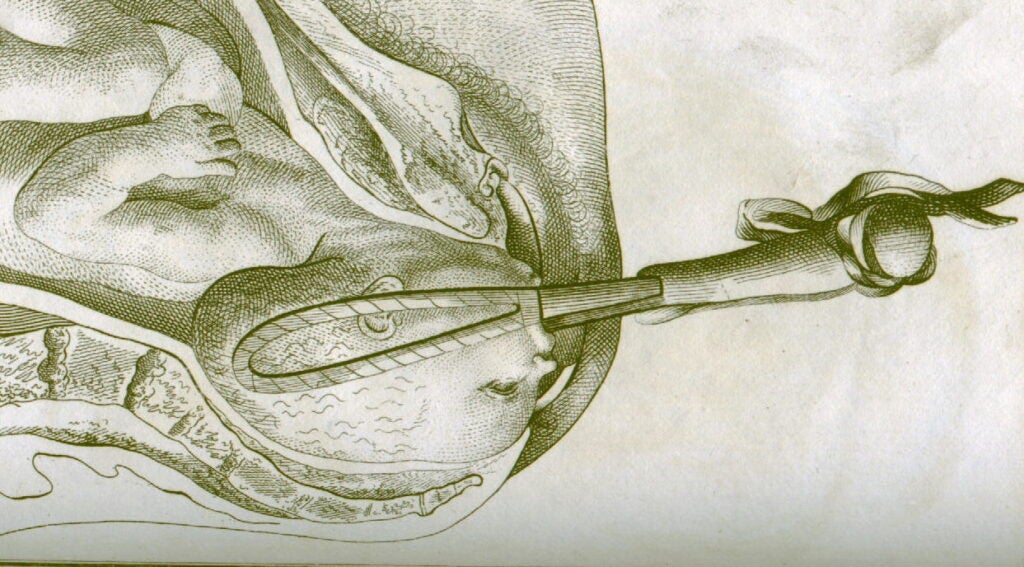 18th-century illustration of forceps