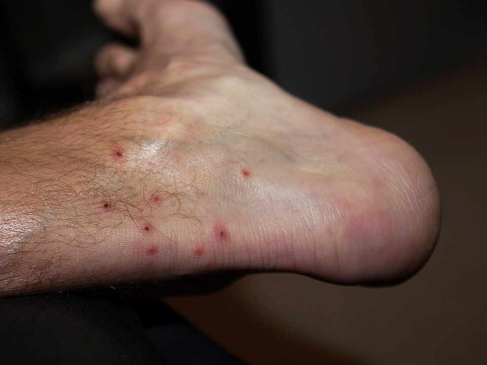 A foot showing several chigger bites.