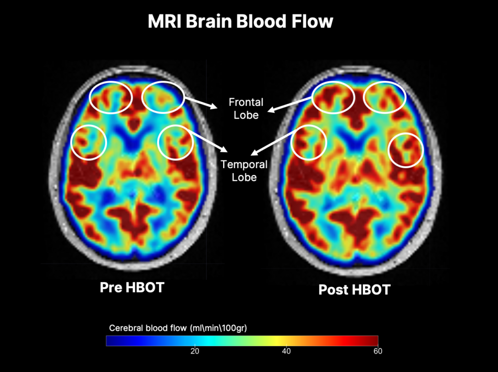 A heat map of brain activity prior to after therapy
